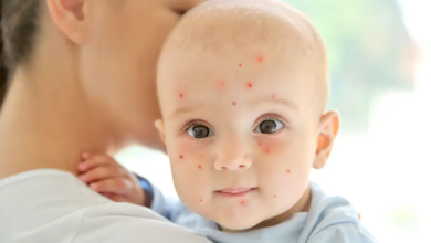 UAE doctors caution residents about chickenpox ahead of summer