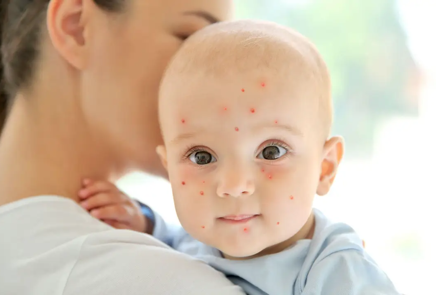 UAE doctors caution residents about chickenpox ahead of summer