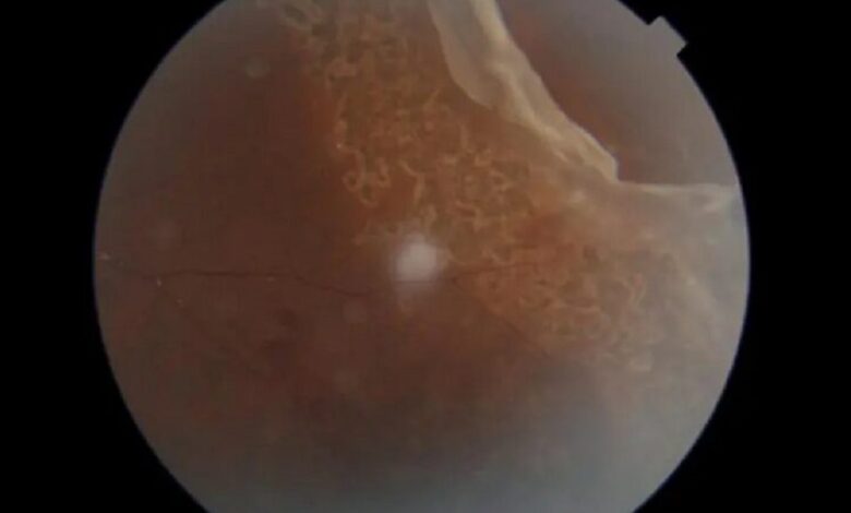 UAE: 13-year-old Indian boy's sight saved after rare cricket ball injury